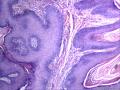 肛周包块，是发鳞状上皮乳头状瘤还是纤维上皮性息肉图3