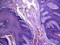肛周包块，是发鳞状上皮乳头状瘤还是纤维上皮性息肉图9