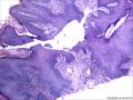 肛周包块，是发鳞状上皮乳头状瘤还是纤维上皮性息肉图4