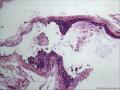 上颌窦囊肿图1