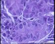 桥本甲状腺炎伴乳头状癌？为何淋巴细胞浸润的区域都有疑似乳头状腺癌腺体？图10