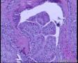 桥本甲状腺炎伴乳头状癌？为何淋巴细胞浸润的区域都有疑似乳头状腺癌腺体？图8