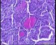 桥本甲状腺炎伴乳头状癌？为何淋巴细胞浸润的区域都有疑似乳头状腺癌腺体？图2