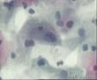 这几个细胞可以报LSIL,HPV 感染吗？图1