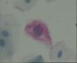 这几个细胞可以报LSIL,HPV 感染吗？图2