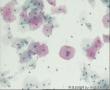 这几个细胞可以报LSIL,HPV 感染吗？图10