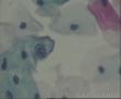 这几个细胞可以报LSIL,HPV 感染吗？图6