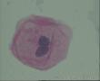 这几个细胞可以报LSIL,HPV 感染吗？图3