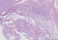透明细胞乳头状细胞癌？还是透明细胞癌+乳头状肾细胞癌？图12