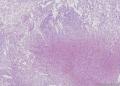 透明细胞乳头状细胞癌？还是透明细胞癌+乳头状肾细胞癌？图11