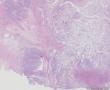 透明细胞乳头状细胞癌？还是透明细胞癌+乳头状肾细胞癌？图5