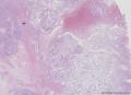 透明细胞乳头状细胞癌？还是透明细胞癌+乳头状肾细胞癌？图4