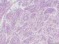 透明细胞乳头状细胞癌？还是透明细胞癌+乳头状肾细胞癌？图13