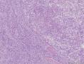 透明细胞乳头状细胞癌？还是透明细胞癌+乳头状肾细胞癌？图6