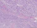 透明细胞乳头状细胞癌？还是透明细胞癌+乳头状肾细胞癌？图7