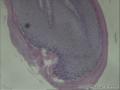 肛周赘生物，有挖空细胞吗图1