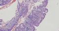 子宫内膜中的鳞状上皮，腺体鳞化图6