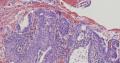 子宫内膜中的鳞状上皮，腺体鳞化图1