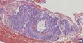 子宫内膜中的鳞状上皮，腺体鳞化图2