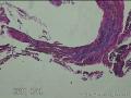 甲状腺峡部肿块图10