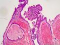 肛旁肿物 乳头状汗腺瘤图6
