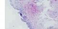 乳腺癌根治术乳头图2