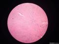 卵巢肿瘤，合并有成熟性囊性畸胎瘤图7
