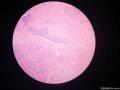 卵巢肿瘤，合并有成熟性囊性畸胎瘤图2