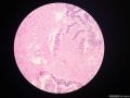 卵巢肿瘤，合并有成熟性囊性畸胎瘤图4