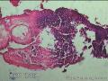 宫颈管内膜组织图14