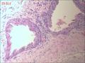 甲状腺区肿物，边缘囊壁样组织见不典型突起图21