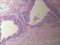 甲状腺区肿物，边缘囊壁样组织见不典型突起图7