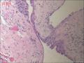 甲状腺区肿物，边缘囊壁样组织见不典型突起图2