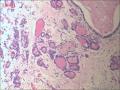 甲状腺区肿物，边缘囊壁样组织见不典型突起图14