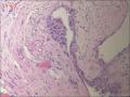 甲状腺区肿物，边缘囊壁样组织见不典型突起图8