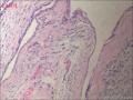 甲状腺区肿物，边缘囊壁样组织见不典型突起图12