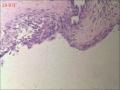 甲状腺区肿物，边缘囊壁样组织见不典型突起图3