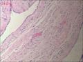甲状腺区肿物，边缘囊壁样组织见不典型突起图11