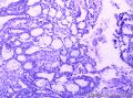 宫颈腺癌、腺样基底细胞癌图4