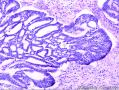 宫颈腺癌、腺样基底细胞癌图9