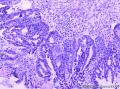 宫颈腺癌、腺样基底细胞癌图5