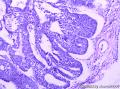 宫颈腺癌、腺样基底细胞癌图6