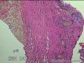 右侧精索鞘膜图19
