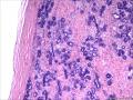 乳腺包块，纤维腺瘤的背景，其时有一个境界清楚的腺体密集区，请老师们指导！图1