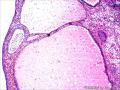 宫颈外口赘生物图11