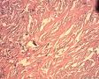 纤维组织细胞瘤？图7