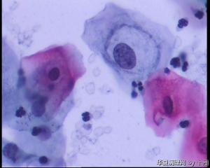 请教：宫颈液基、随处可见的核周空晕细胞是挖空细胞吗？图3