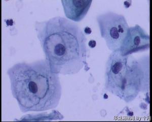 请教：宫颈液基、随处可见的核周空晕细胞是挖空细胞吗？图7