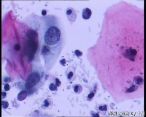 45岁，宫颈液基。图3