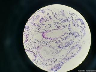 结肠取活检，请问息肉还是腺瘤？图15